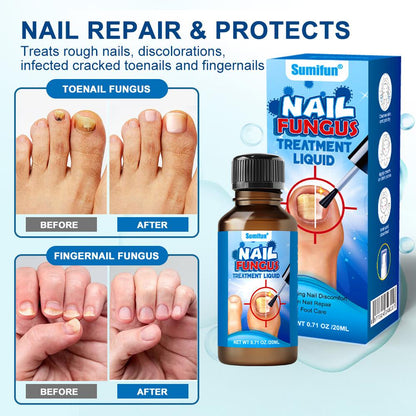 Herbal Anti-Fungal Tree Tea Oil Nail Liquid
