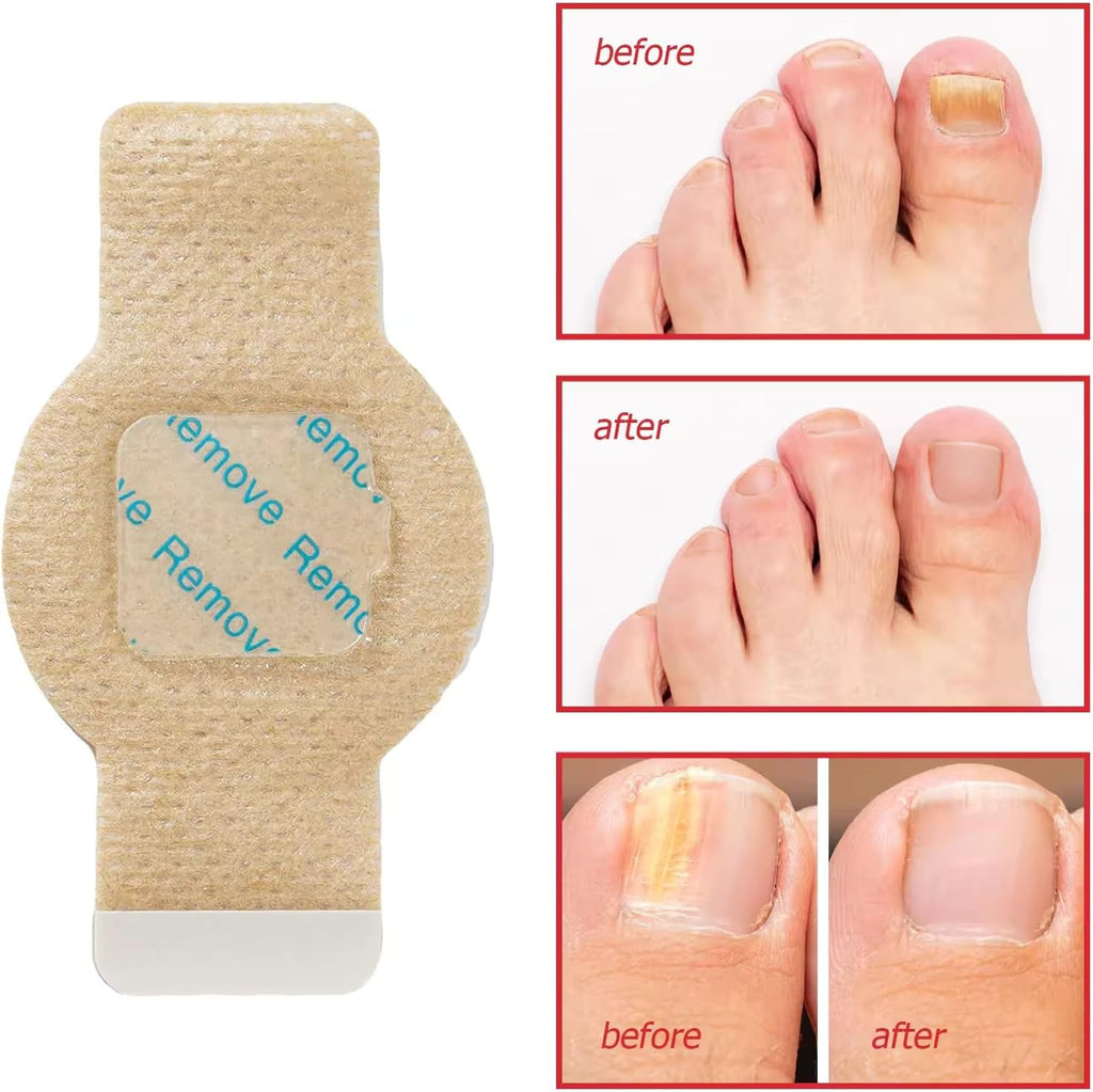 Nighttime Renewal Fungal Nail Treatment Patches