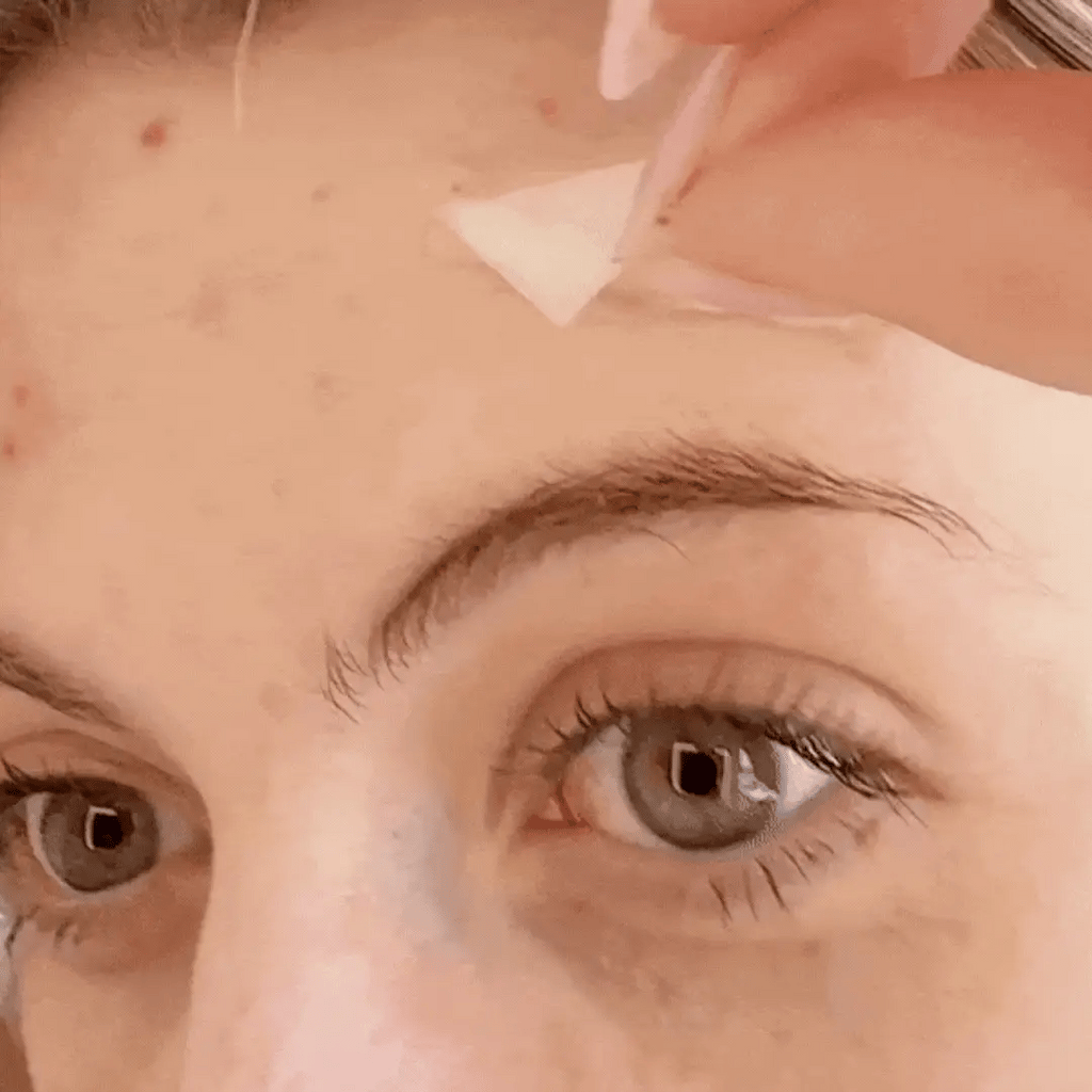 Hydrocolloid Patch Bandages for Wound & Acne Care