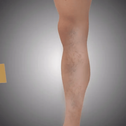 VeinEase™ Turmeric Varicose Vein Patches | 🔥