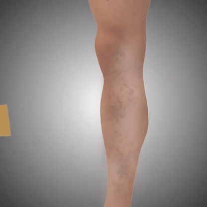 VeinEase™ Turmeric Varicose Vein Patches | 🔥