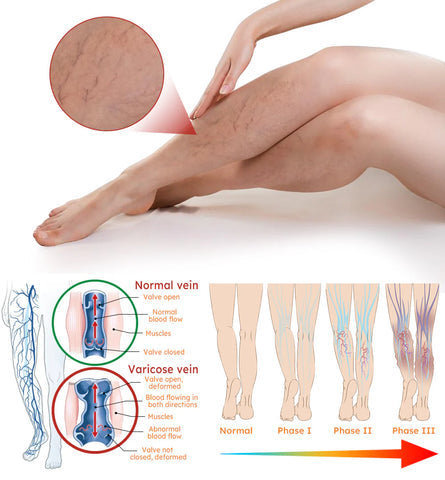 VeinEase™ Turmeric Varicose Vein Patches | 🔥