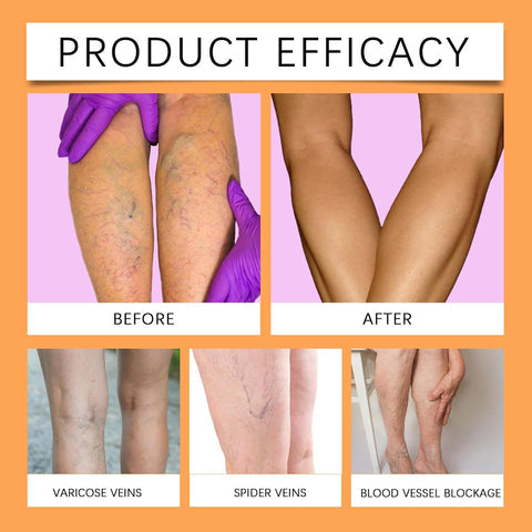 VeinEase™ Turmeric Varicose Vein Patches | 🔥