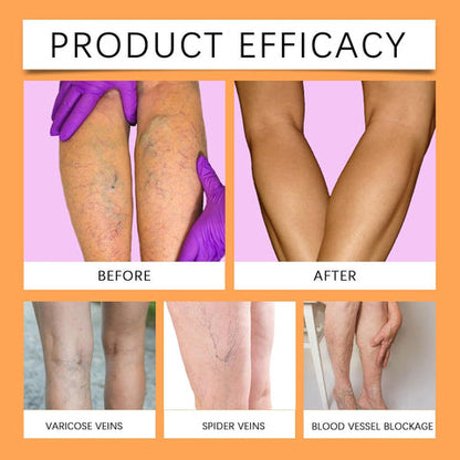 VeinEase™ Turmeric Varicose Vein Patches | 🔥